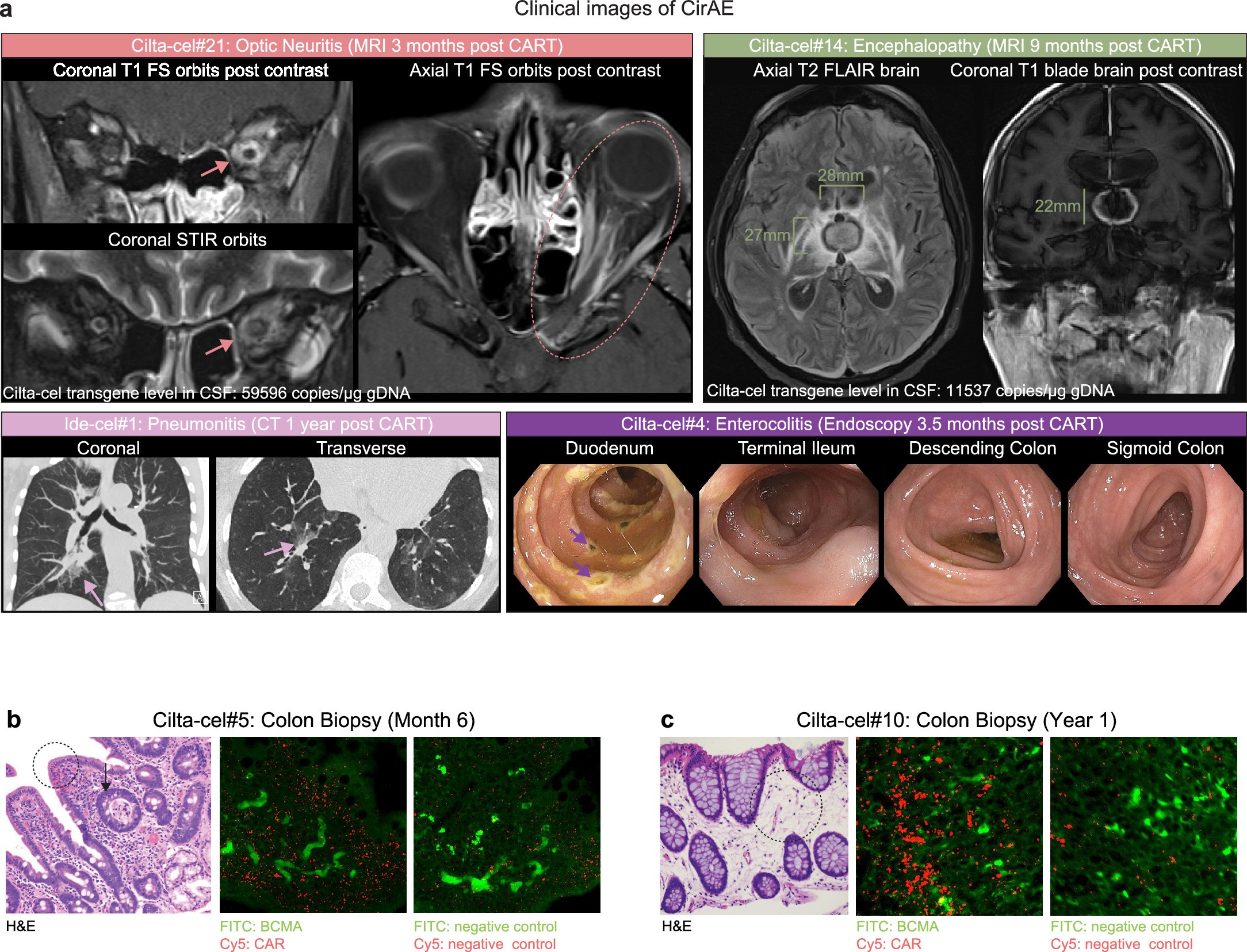 Extended Data Fig. 3: Clinical imaging of CART-associated immune-related adverse events (CirAE) and colon biopsy results in patients who developed immune effector cell-associated enterocolitis.