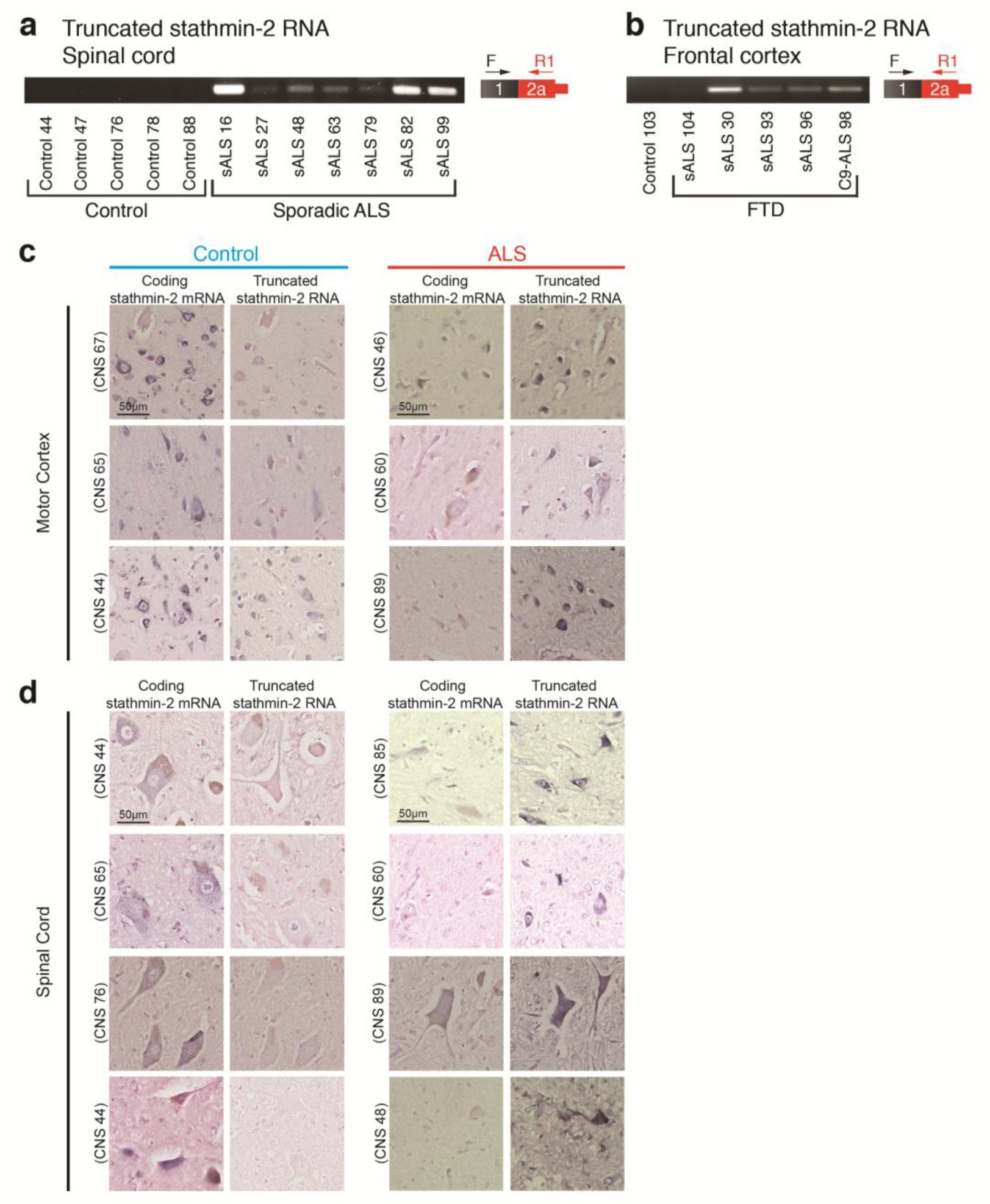 Supplementary Figure 7: Expression of short stathmin-2 RNA is a hallmark of affected spinal motor neurons and motor cortex of sporadic ALS patients.