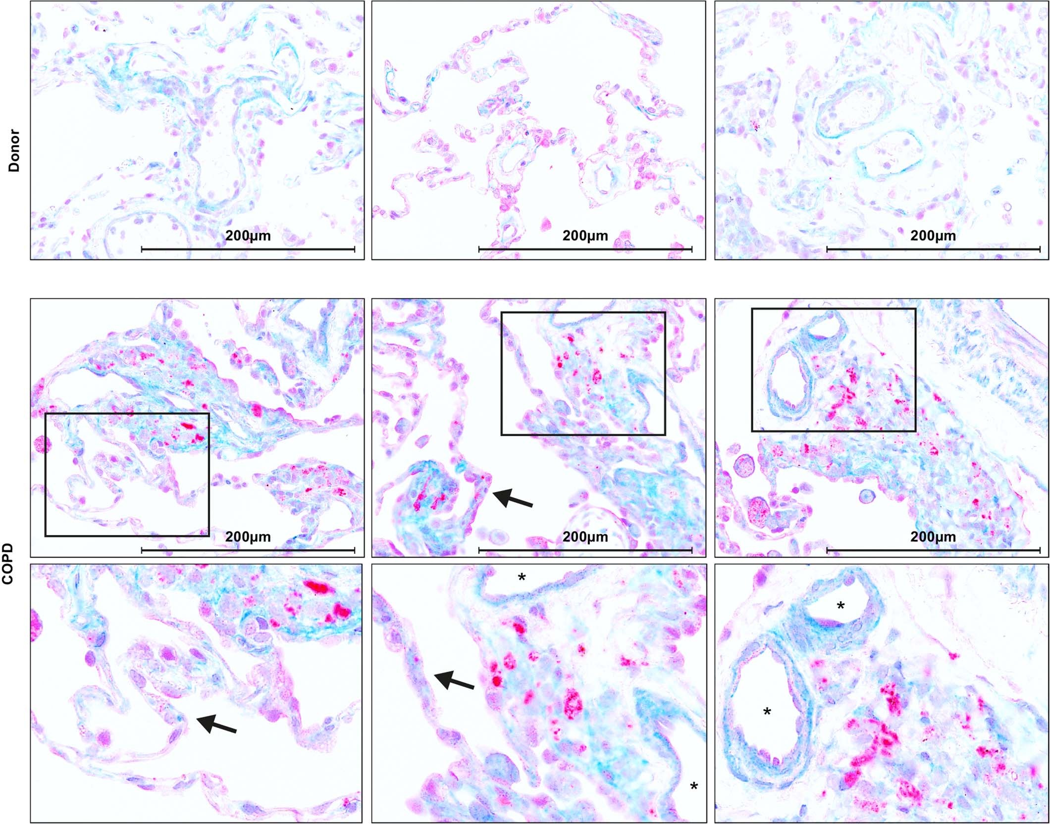 Extended Data Fig. 9: Co-staining of human lung tissue from donor lungs and COPD patients with anti-NoxO1 (light blue), anti-nitrotyrosine (red) and nuclear staining with hematoxylin (dark blue).