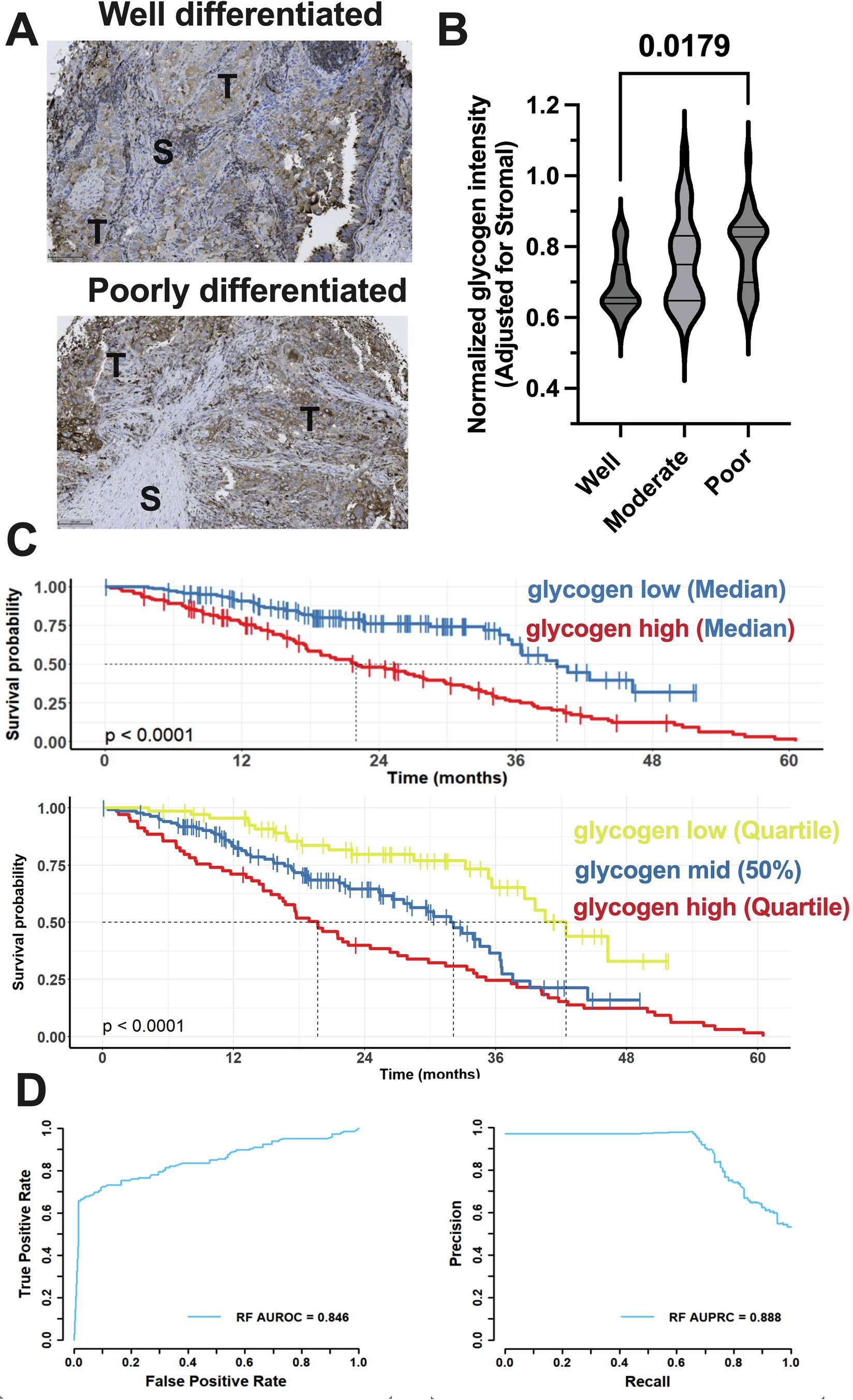 Extended Data Fig. 4: Glycogen accumulation correlates with tumor grade and predicts survival outcomes.