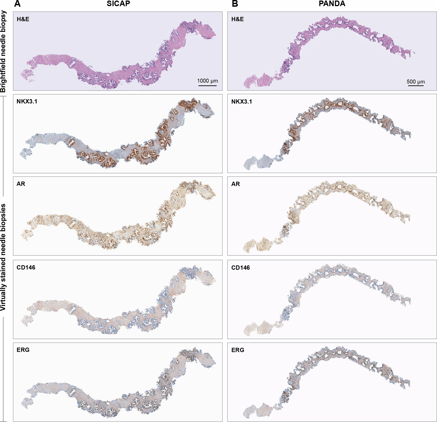 Extended Data Fig. 7: Transfer learning from TMAs to needle biopsies of prostate cancer tissue.