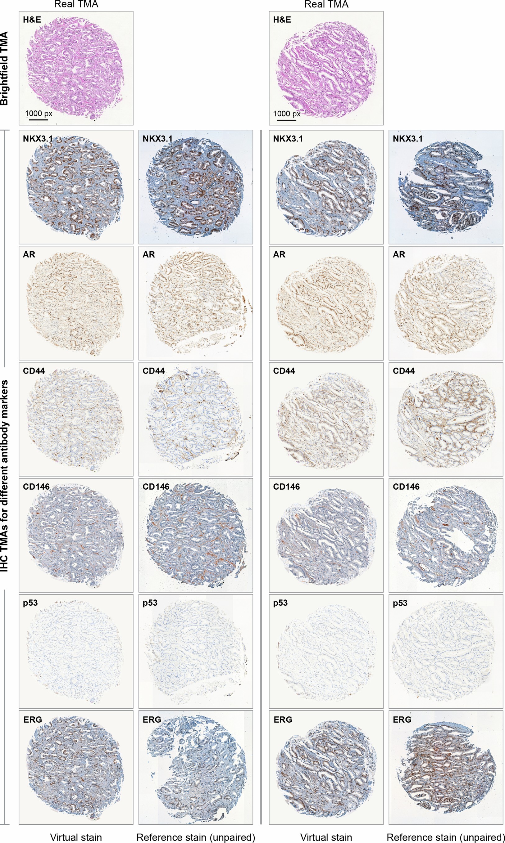 Extended Data Fig. 1: Qualitative evaluation of the VirtualMultiplexer for two TMA cores in the EMPaCT dataset.