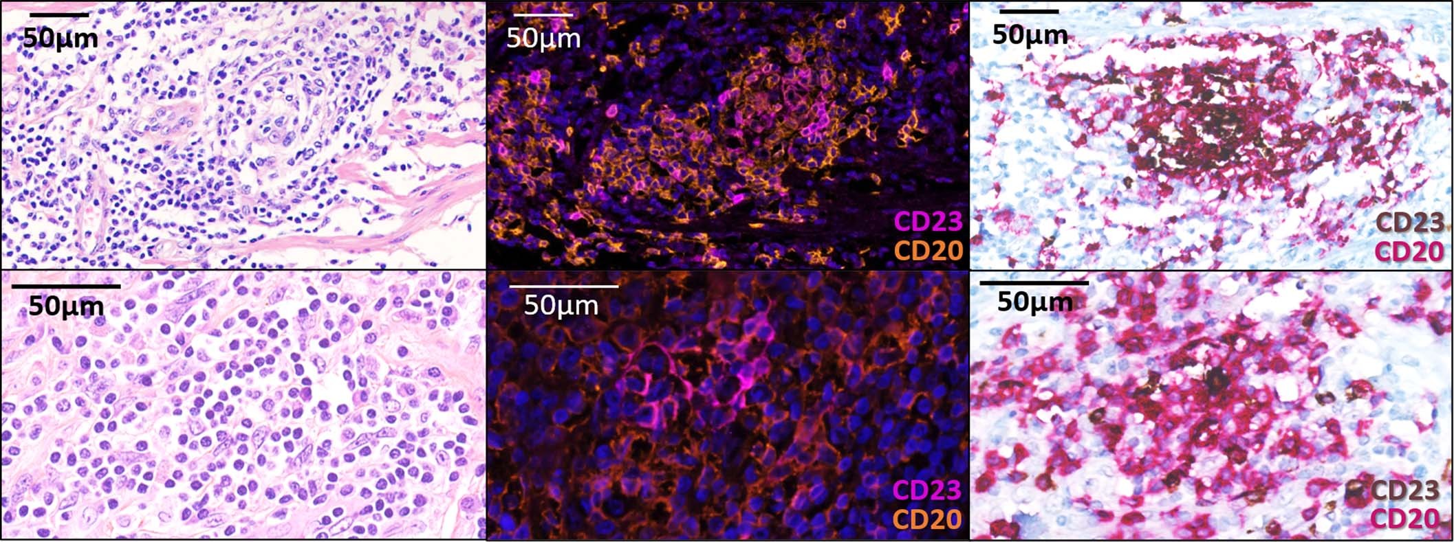 Extended Data Fig. 5: Comparison of the TLS screening with pathology and immunohistochemistry pathology versus the screening with immunofluorescence (method by Petitprez et al).