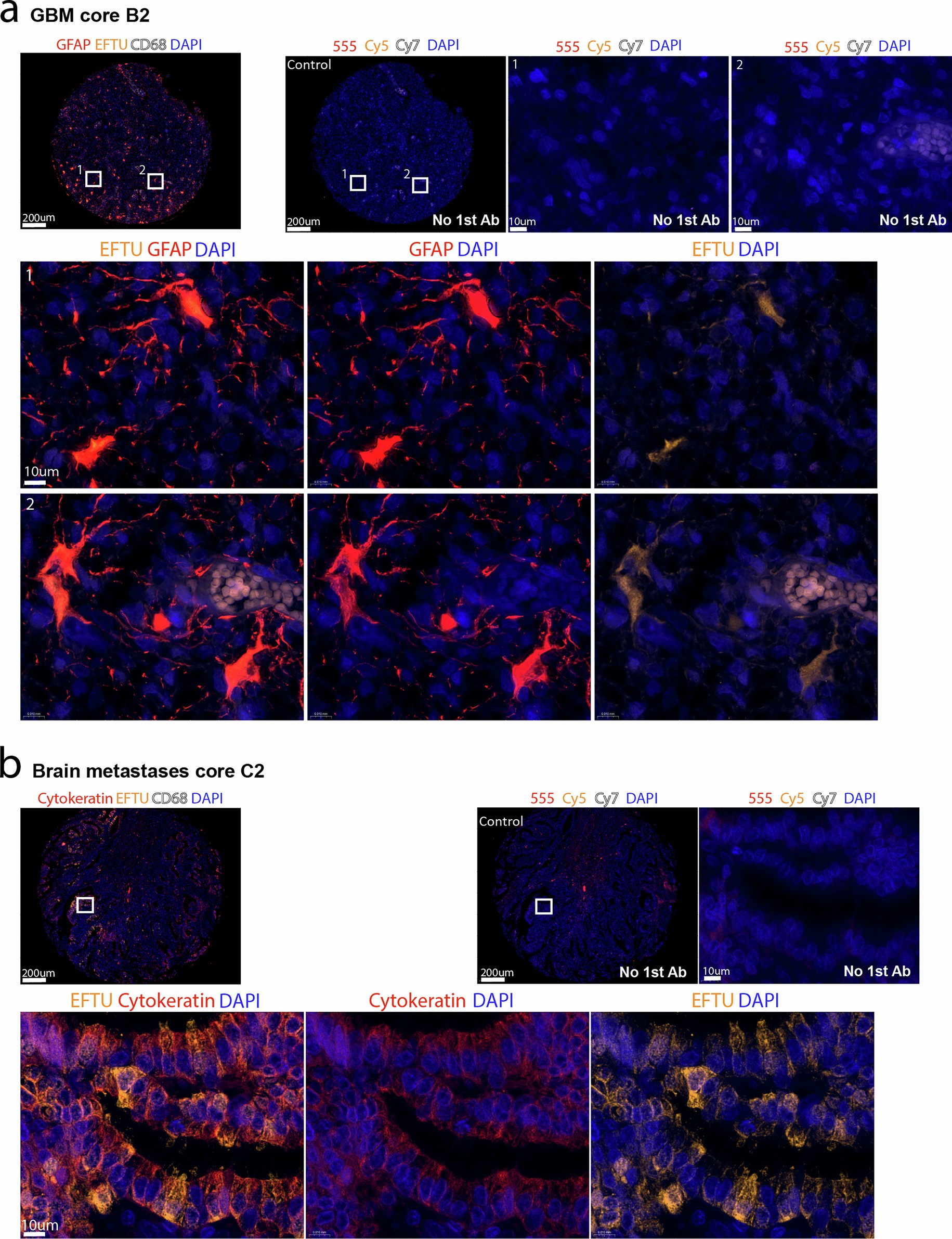 Extended Data Fig. 4: Intratumor bacteria reside inside cancer cells.