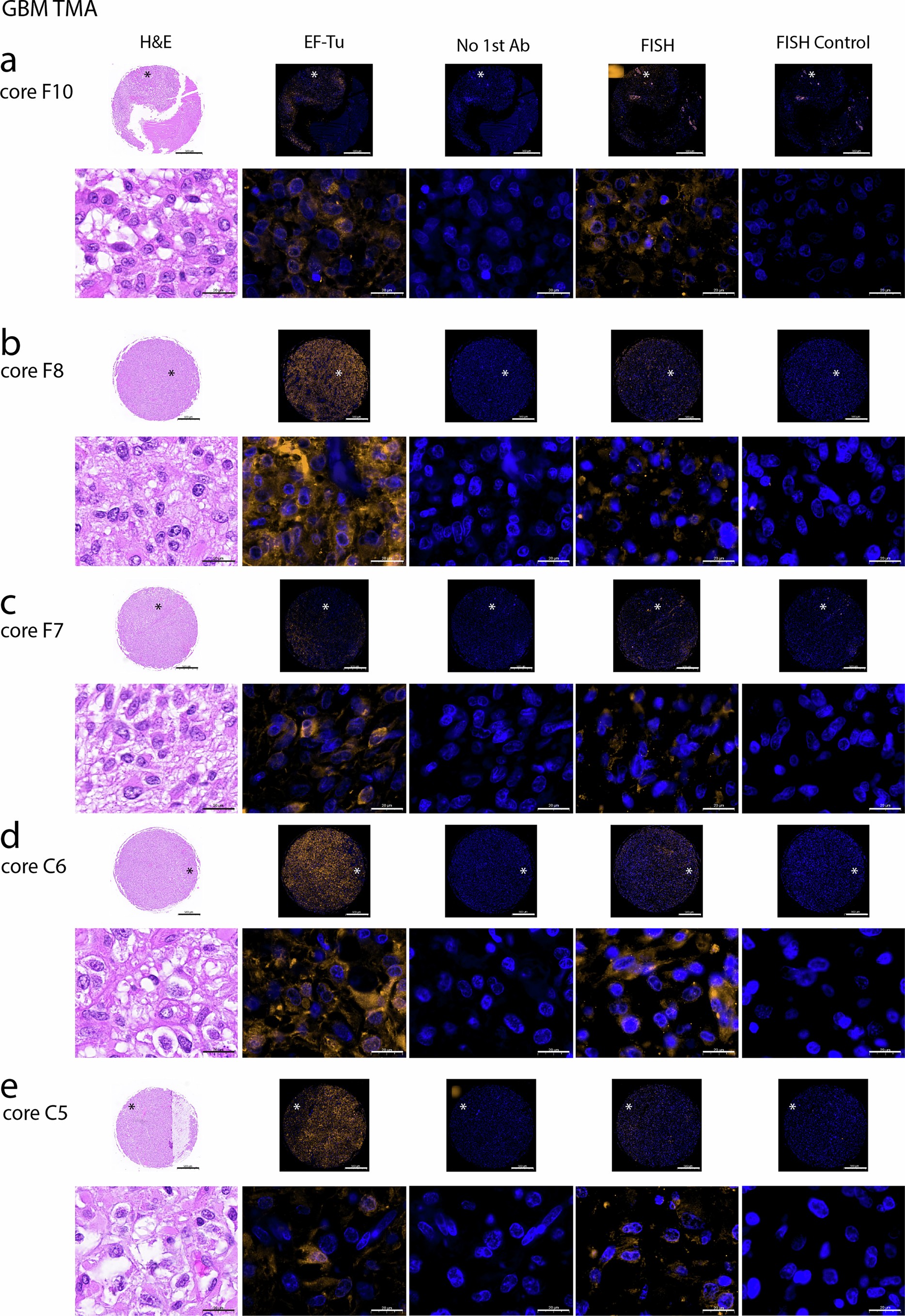 Extended Data Fig. 2: Bacteria are detected within human GBM tumors.