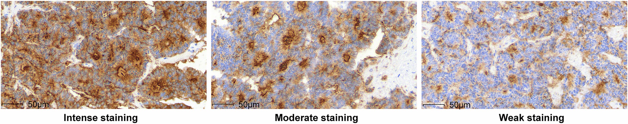 Extended Data Fig. 10: Reference examples for CEA immunohistochemistry staining intensity scoring.