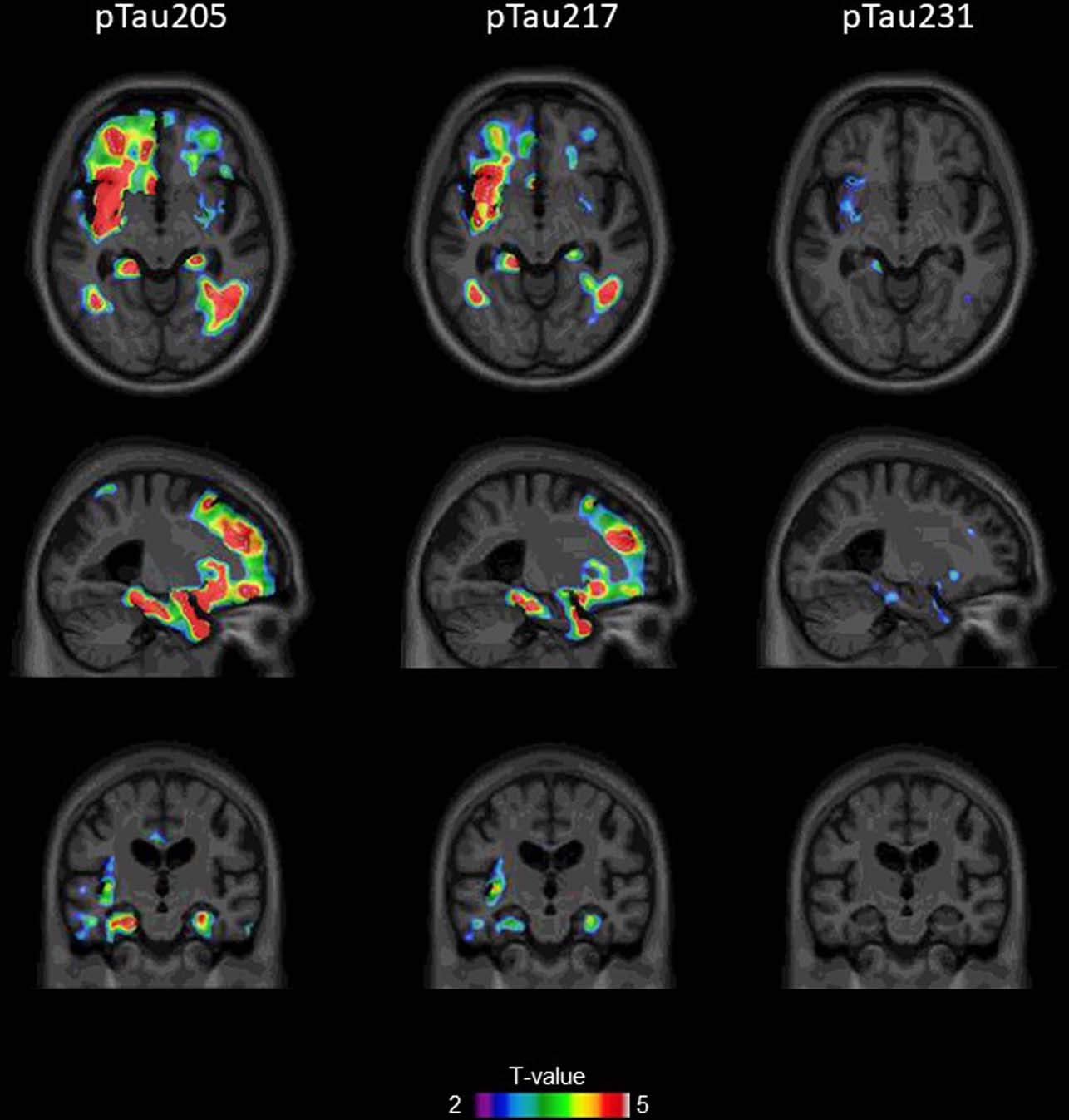 Extended Data Fig. 7: Voxel-wise associations of p-tau205, p-tau217 and p-tau231 with Tau PET uptake.