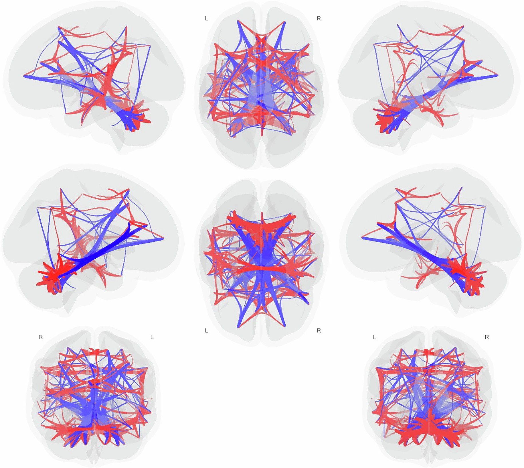 Extended Data Fig. 3: Traumatic Memory Retrieval > Neutral Memory Retrieval in all PTSD individuals (PTSD + PTSD + DS; n = 65) vs Controls (n = 25).