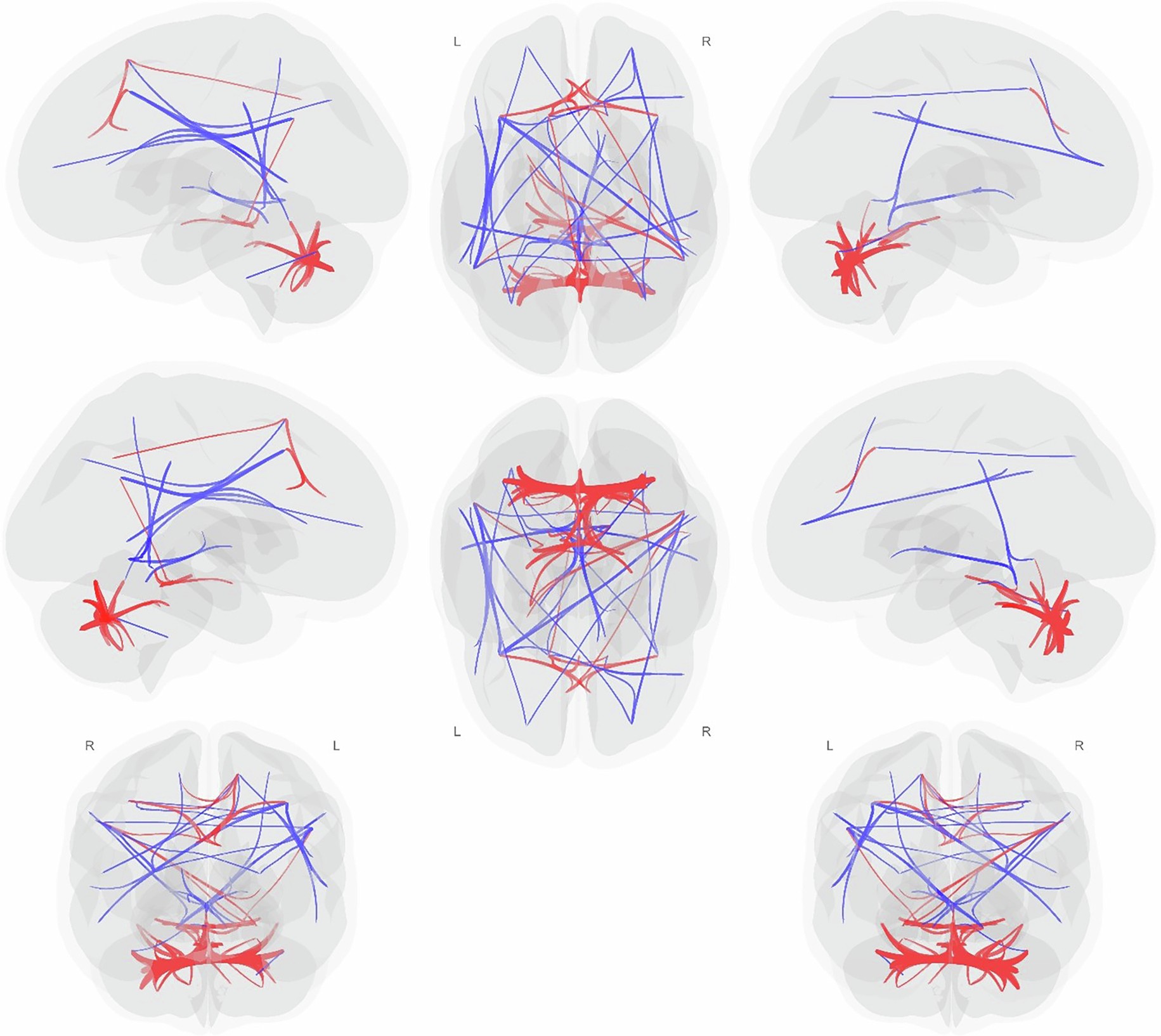 Extended Data Fig. 5: Traumatic Memory Retrieval > Neutral Memory Retrieval in PTSD alone (n = 46) vs Controls (n = 25).