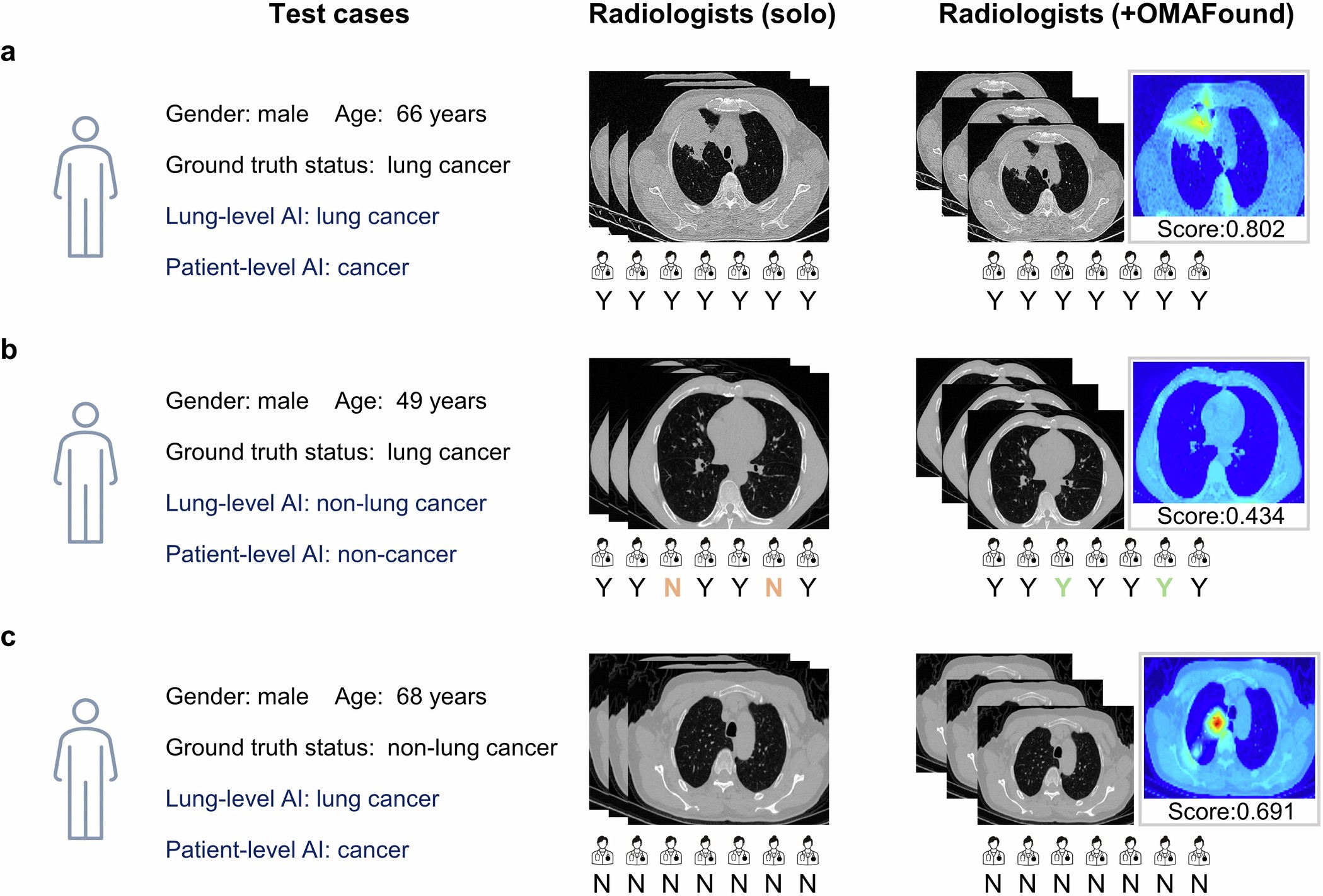 Extended Data Fig. 3: Male examples of radiologist’s decision with and without AI assistance.