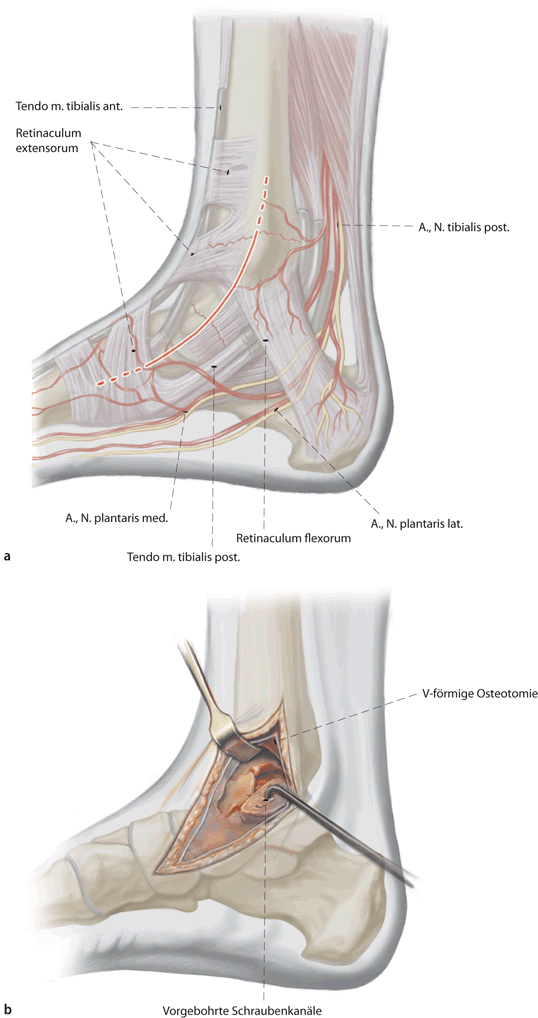 Figure 4 | Osteosynthese zentraler Talusfrakturen | SpringerLink