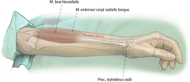 Figure 2 | Die operative Dekompression des Ramus superficialis des Nervus  radialis | SpringerLink