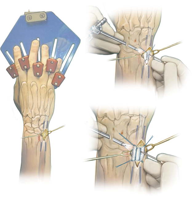 Figure 3 | Die arthroskopisch unterstützte transkapsuläre Refixation des  Discus triangularis am Handgelenk | SpringerLink
