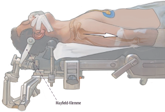 Figure 1 | Dekompression beim zervikalen Bandscheibenvorfall in  vollendoskopischer, ventraler Technik | SpringerLink