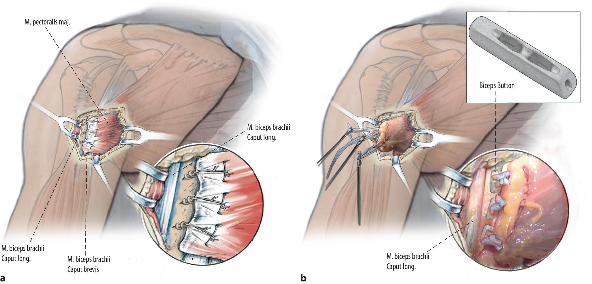 Figure 7 | Surgical repair of acute pectoralis major muscle ruptures |  SpringerLink