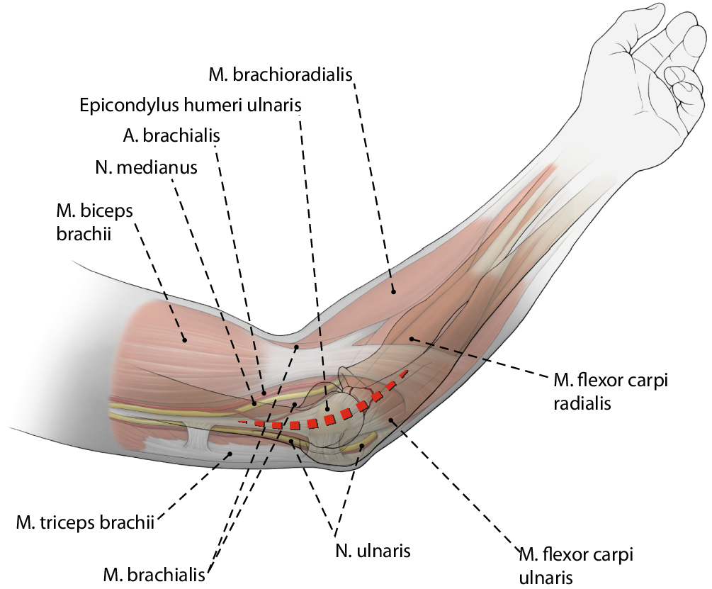Figure 3  Plattenosteosynthese des Processus coronoideus ulnae 