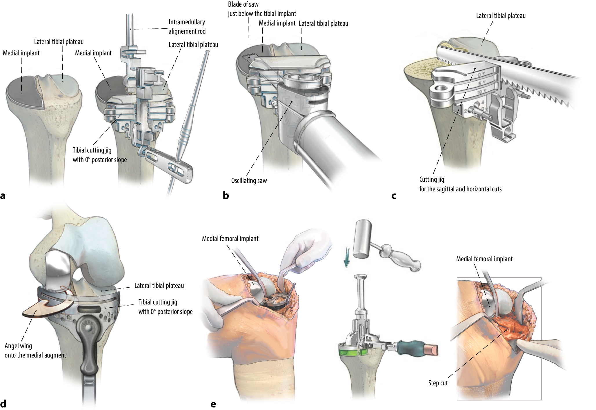 Figure 4 | Revision of unicompartmental knee arthroplasty using the in situ  referencing technique | SpringerLink