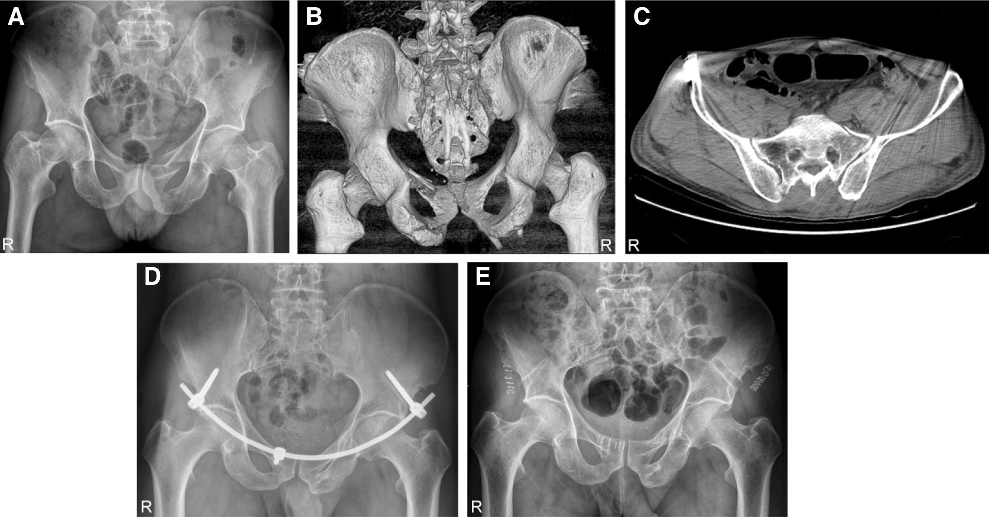 Figure 1 | Modified internal fixator for anterior pelvic ring fractures  versus conventional two-screw fixation | SpringerLink