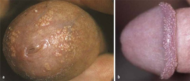 Hirsuties papillaris penis