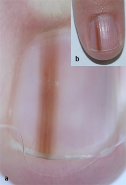 Figure 16 | Dermatoskopie der Nägel | SpringerLink