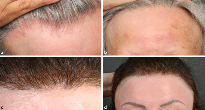Figure 1 | Postmenopausaler Lichen planopilaris alias fibrosierende  frontotemporale Alopezie Kossard | SpringerLink