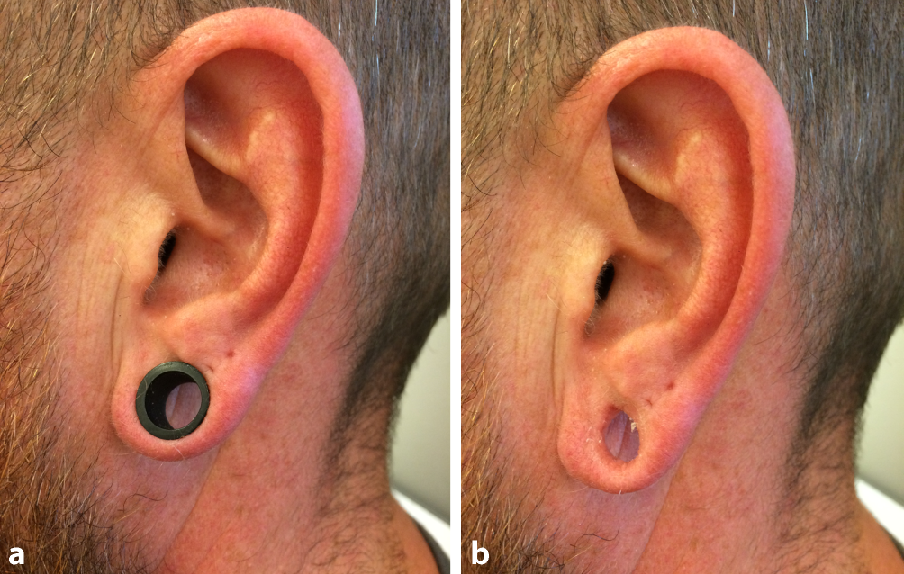 Figure 2 | Komplikationen bei kosmetischen Piercings und Tätowierungen im  Kopf-Hals-Bereich | SpringerLink
