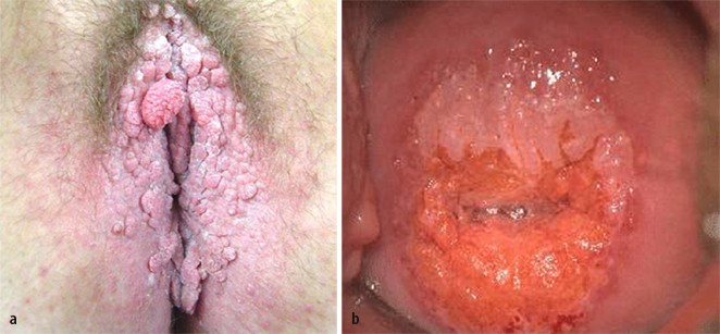hpv impfung condylome)
