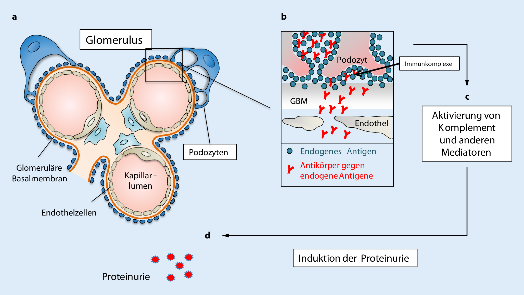 Figure 1 Membranose Glomerulonephritis Springerlink