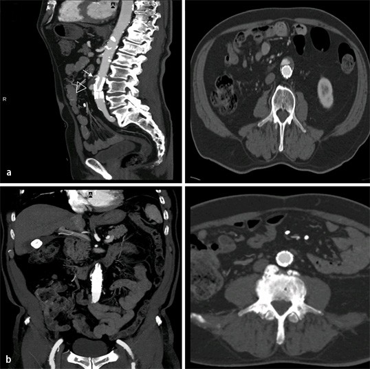 Figure 11 Ct Angiographie Der Aorta Springerlink