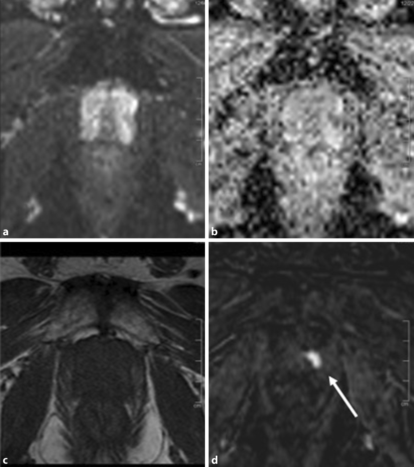 prostatectomie radicala complicatii