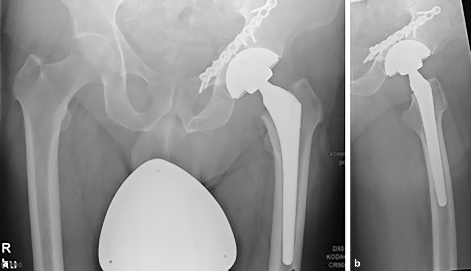Figure 10 | Schaftschmerz in der Knie- und Hüftendoprothetik | SpringerLink