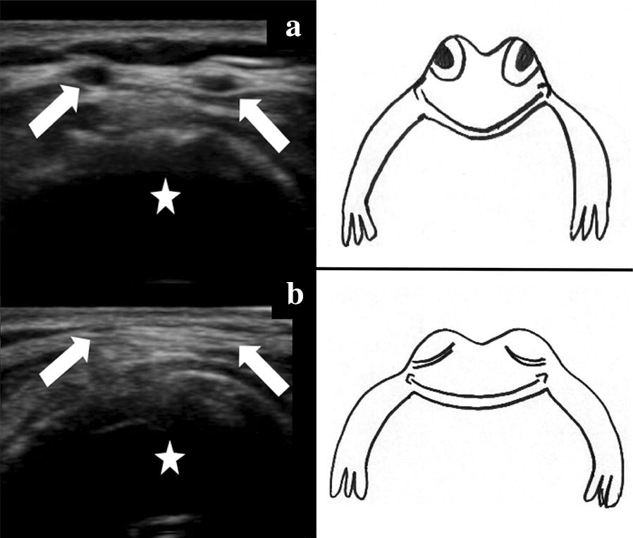 Figure 1 The Blinking Frog Ultrasound Sign Establishes The Presence Of Pretracheal Vasculature Springerlink