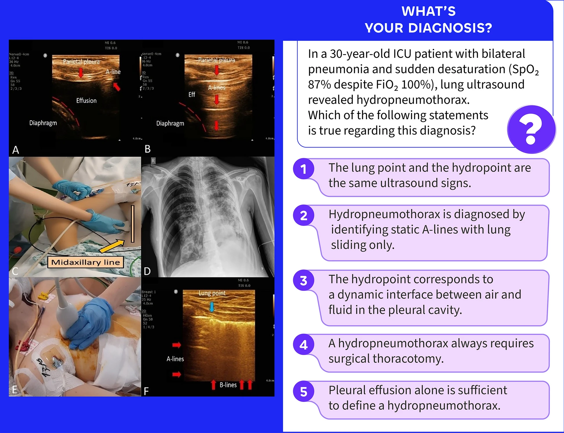 [Intensive Care Medicine影像]：水中的气体：液点征
