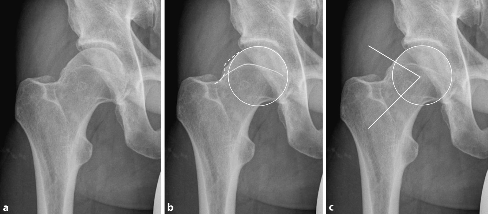 Figure 1 Bildgebung Des Huftgelenks Beim Femoroazetabularen Impingement Springerlink