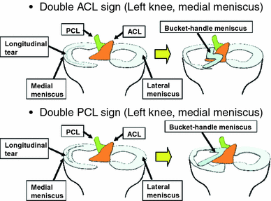 Figure 3 The Double Acl Sign An Unusual Bucket Handle Tear Of Medial Meniscus Springerlink