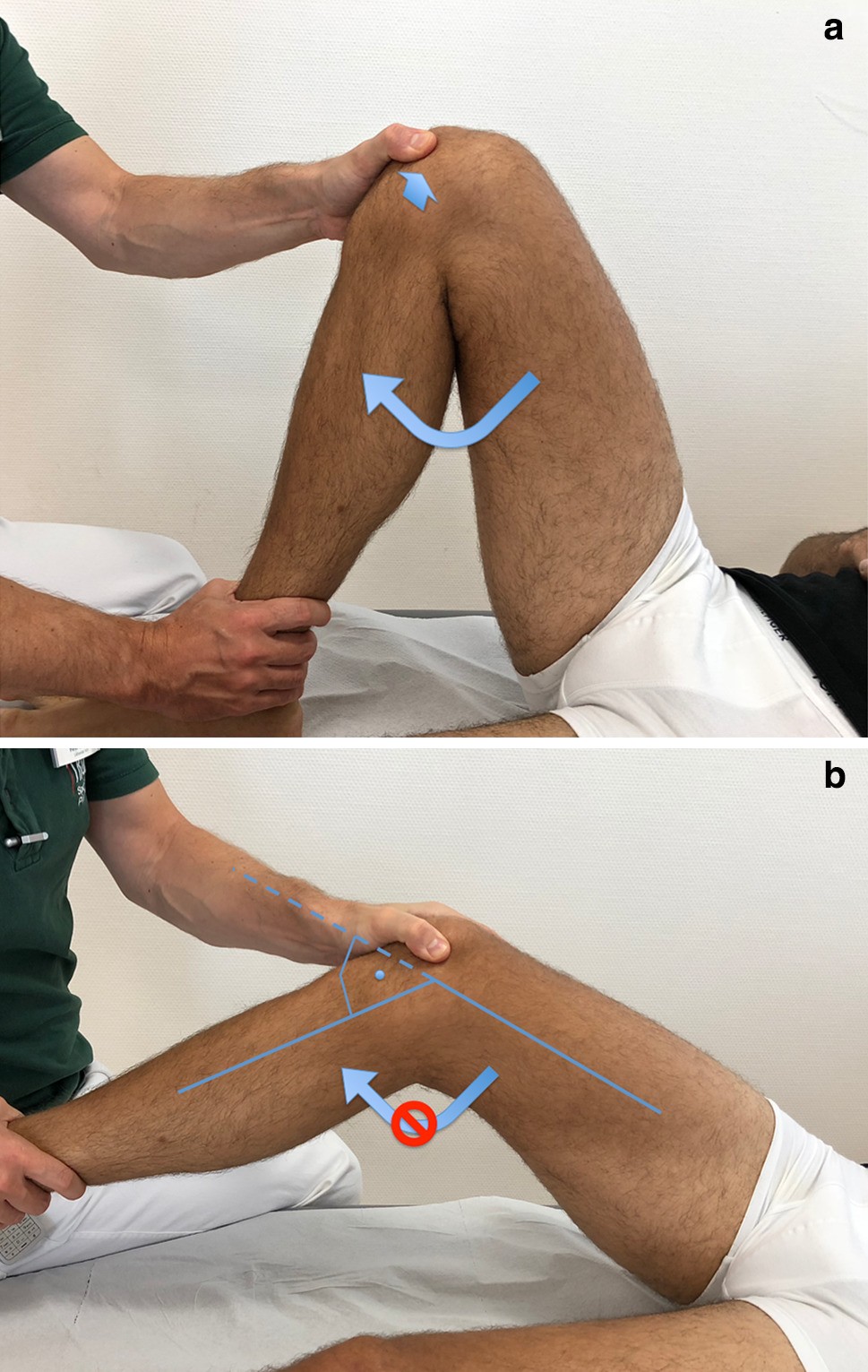 Figure 1 The Reversed Dynamic Patellar Apprehension Test Mimics Anatomical Complexity In Lateral Patellar Instability Springerlink