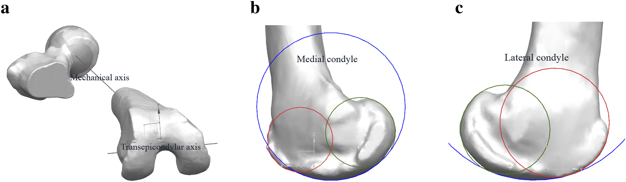 Figure 1 Gender Difference Exists In Sagittal Curvature Of The Distal Femoral Condyle Morphology For Osteoarthritic Population Springerlink