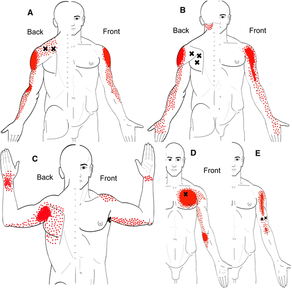 travell and simons pain referral