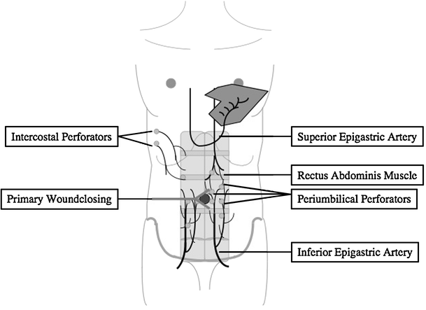 Figure 5 | Pedicled superior epigastric perforator flap for reconstruction  of a soft tissue defect at the ventral thoracic wall | SpringerLink