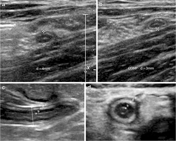 Figure 1 | Ultrasound of the pediatric appendix | SpringerLink