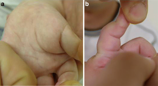 Figure 1 | Fibrous hamartoma of infancy in the hand: unusual location and  MR imaging findings | SpringerLink