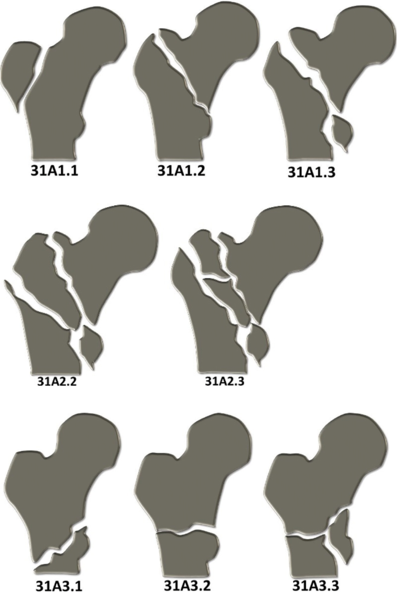 Figure 11 Fragility Fractures Of The Proximal Femur Review And Update For Radiologists Springerlink