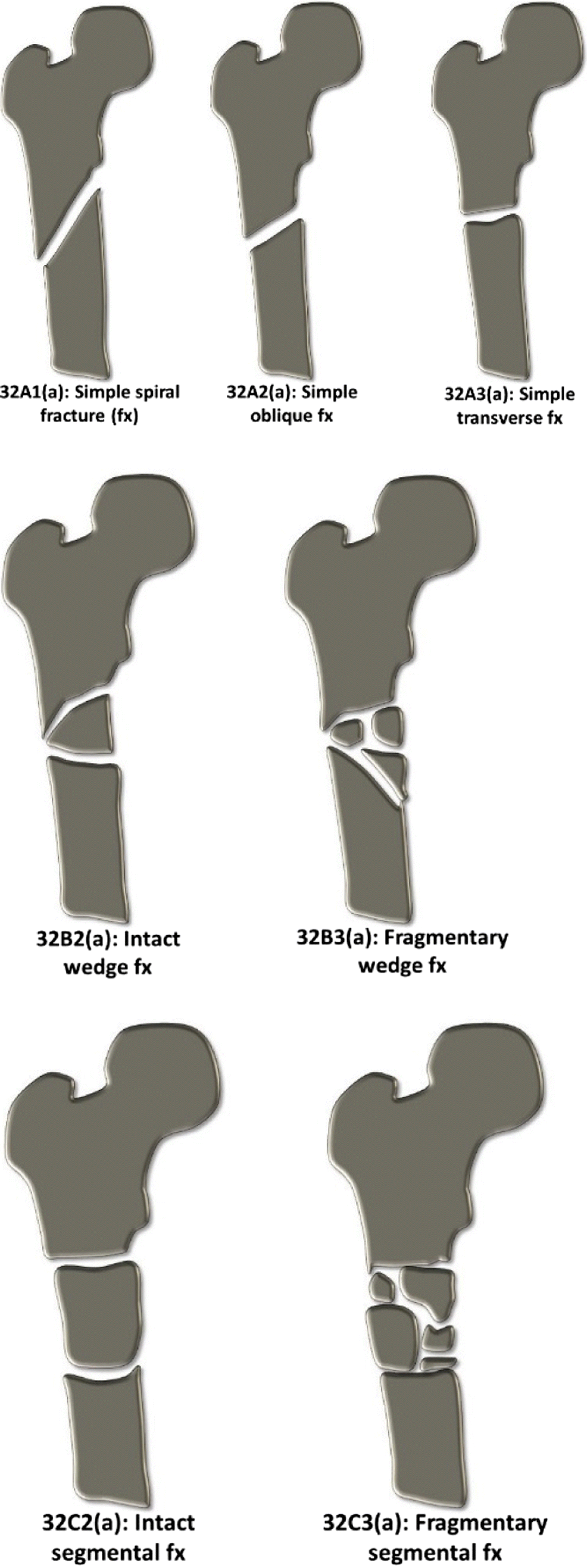 Figure 19 Fragility Fractures Of The Proximal Femur Review And Update For Radiologists Springerlink
