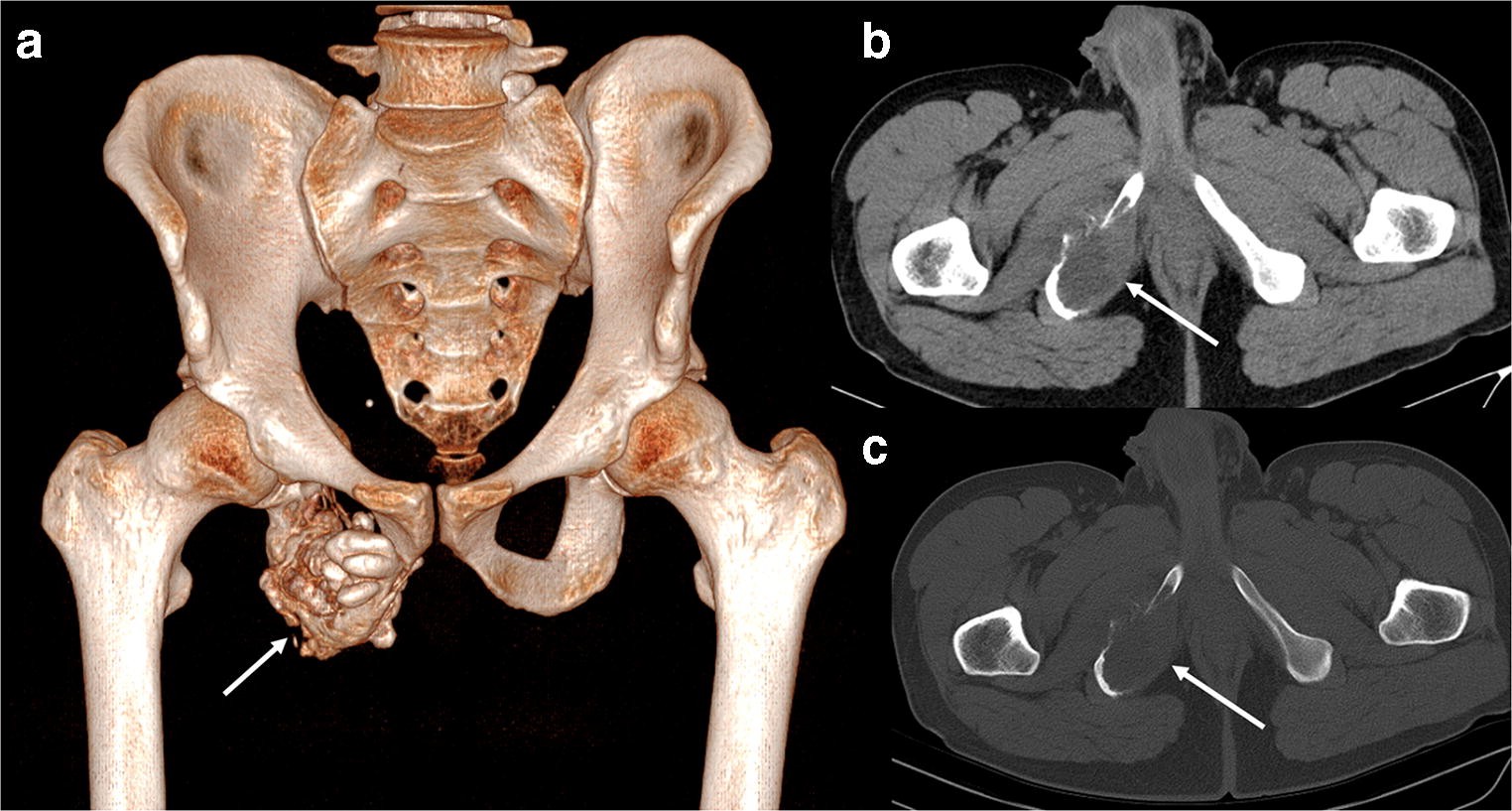Figure 5 Pelvic Bone Tumor Resection What A Radiologist Needs To Know Springerlink