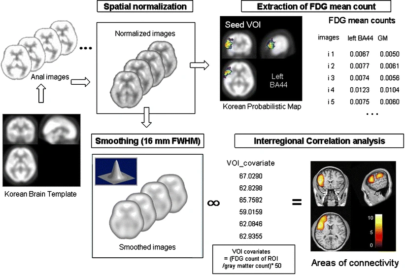 Metabolic connectivity by interregional correlation analysis using statistical parametric mapping (SPM) and FDG brain PET; methodological development and patterns of metabolic connectivity in adults
