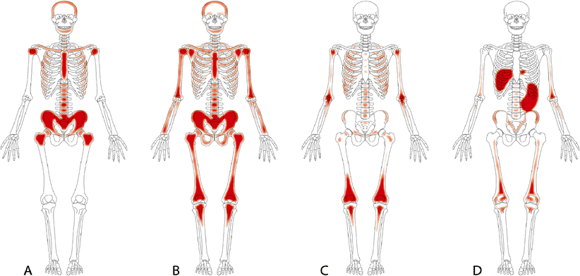 Figure 1 Radionuclide Imaging Of Bone Marrow Disorders Springerlink