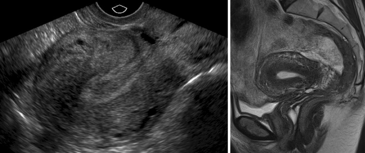 Figure 4 Accuracy Of Findings In The Diagnosis Of Uterine Adenomyosis On Ultrasound Springerlink