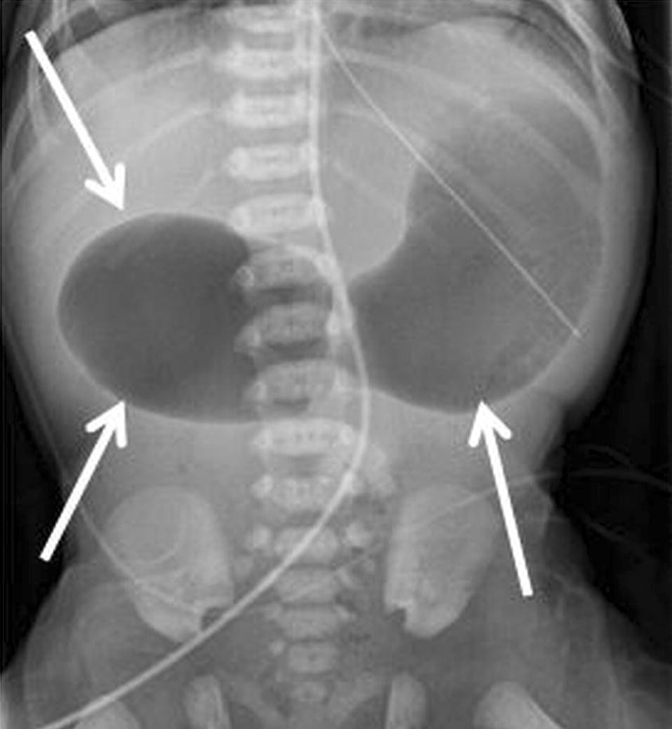 Figure 6 Pathognomonic Imaging Signs In Abdominal Radiology Springerlink Figure 6 Pathognomonic Imaging Signs In Abdominal Radiology Springerlink