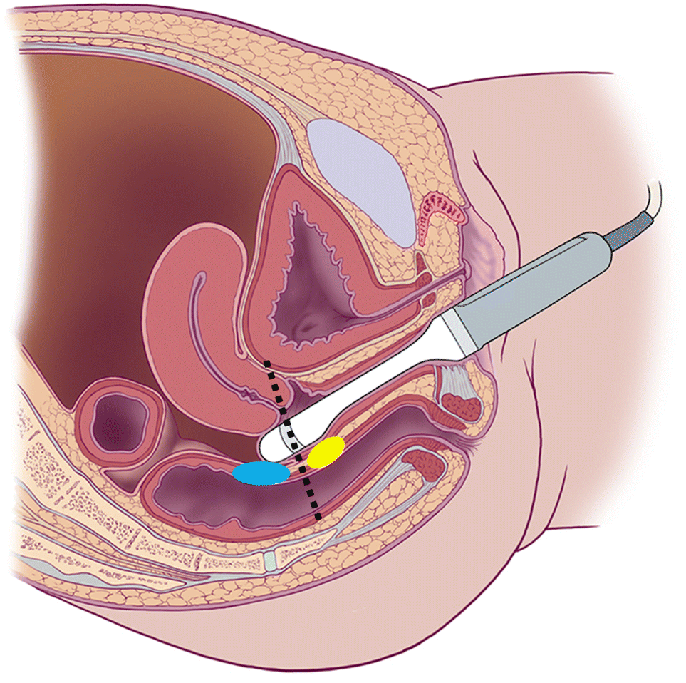 Figure 7 | Sonographer-acquired ultrasound protocol for deep endometriosis | SpringerLink Figure 7 | Sonographer-acquired ultrasound protocol for deep endometriosis | SpringerLink