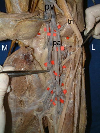 Figure 2 Anatomic Variations Of Popliteal Artery That May Be A Reason For Entrapment Springerlink Figure 2 Anatomic Variations Of Popliteal Artery That May Be A Reason For Entrapment Springerlink